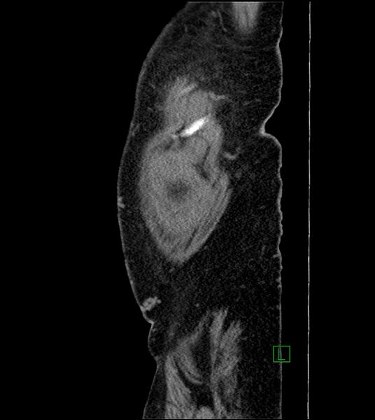 File:Closed-loop small bowel obstruction-internal hernia (Radiopaedia 78439-91096 C 134).jpg