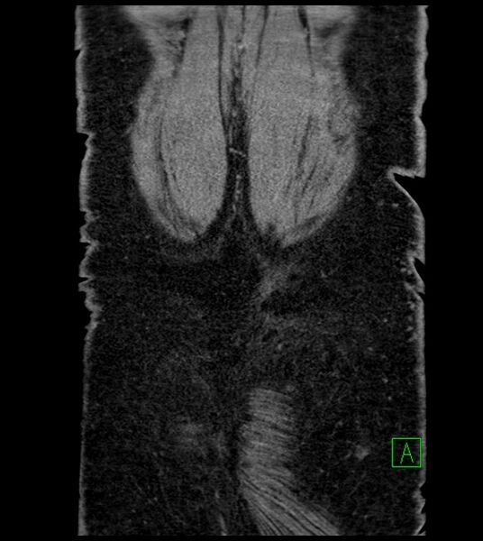 File:Closed-loop small bowel obstruction-internal hernia (Radiopaedia 78439-91096 Coronal non-contrast 96).jpg