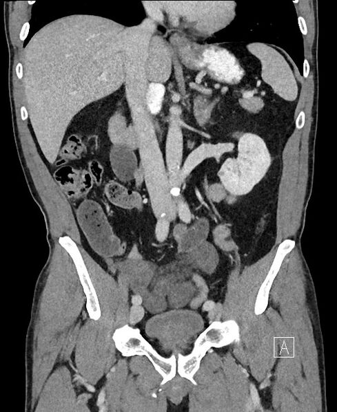 File:Closed loop small bowel obstruction - internal hernia (Radiopaedia 57806-64778 A 55).jpg