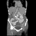 Closed loop small intestinal obstruction (Radiopaedia 16156-15835 Coronal non-contrast 4).png