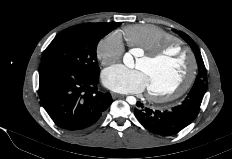 File:Coarctation of aorta with aortic valve stenosis (Radiopaedia 70463-80574 A 133).jpg