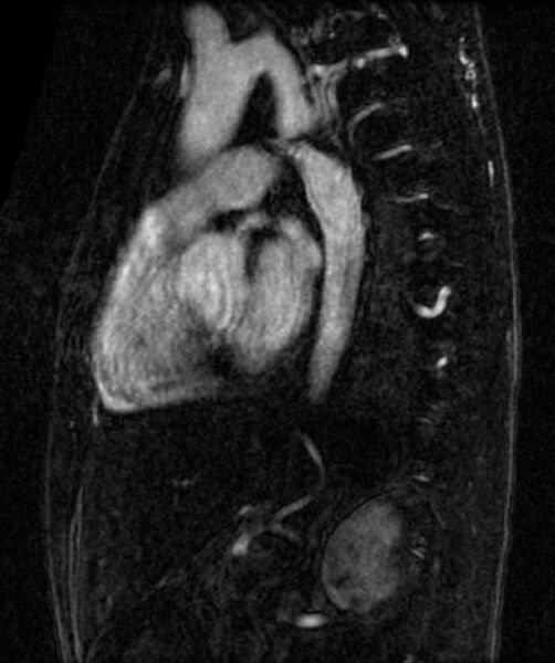File:Coarctation of the aorta (Radiopaedia 11320-11684 Sagittal MRA 1).jpg