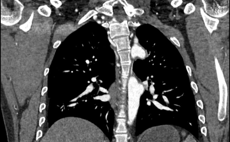 File:Coarctation of the aorta (Radiopaedia 53363-59343 C 45).jpg