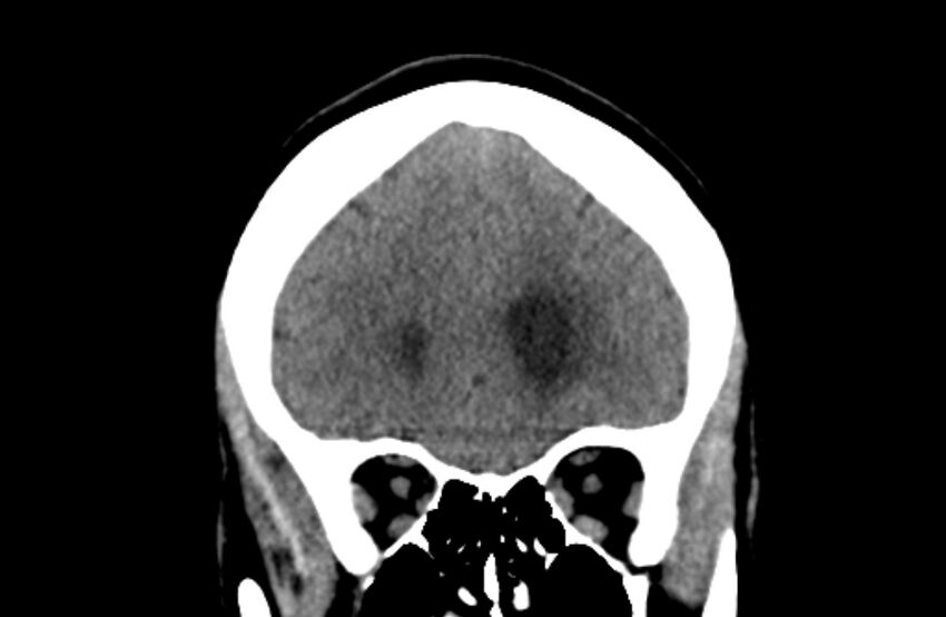 Colloid cyst (Radiopaedia 53180-59146 Coronal non-contrast 17).jpg