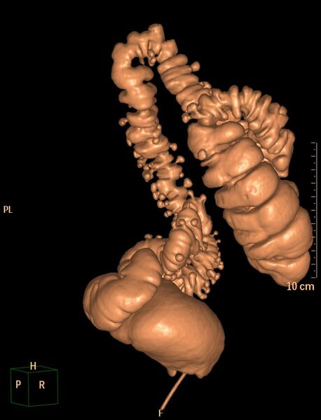 File:Colonic diverticulosis (Radiopaedia 29641-30159 3D VC 8).jpg