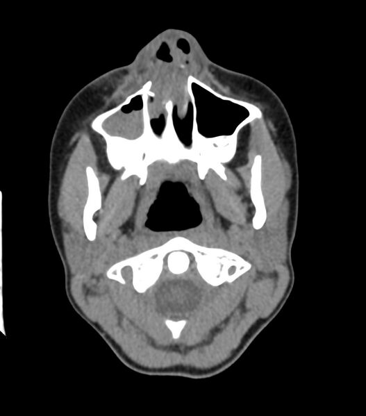 File:Nasoorbitoethmoid fracture (Radiopaedia 90044-107205 Axial non-contrast 108).jpg