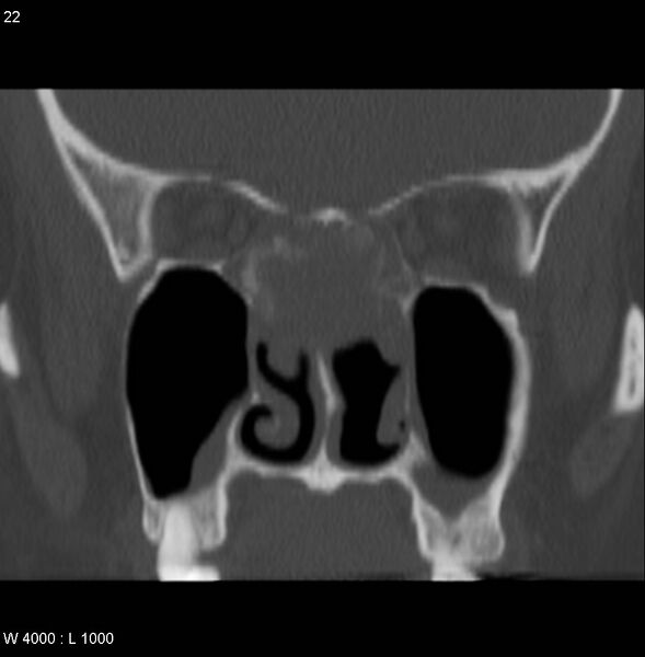 File:Nasopharyngeal carcinoma (recurrent) (Radiopaedia 5061-6903 Coronal bone window 4).jpg