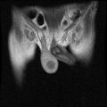 Necrotizing epididymo-orchitis with intra-testicular abscess (Radiopaedia 29397-29860 Coronal T1 C+ 5).jpg
