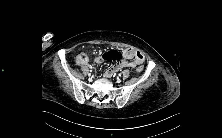 Neo-terminal ileal stricture (Crohn disease) (Radiopaedia 33790-34948 A 353).jpg