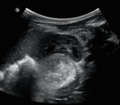 Neonatal neuroblastoma (Radiopaedia 56651-63437 A 1).png