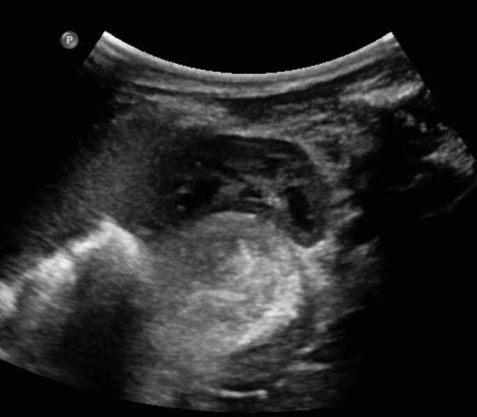 File:Neonatal neuroblastoma (Radiopaedia 56651-63437 A 1).png