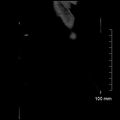 Neonatal neuroblastoma (Radiopaedia 56651-63438 Coronal non-contrast 51).jpg