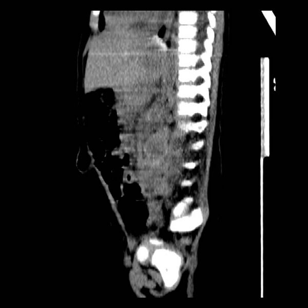 File:Neuroblastoma with skull metastases (Radiopaedia 30326-30960 B 26).jpg