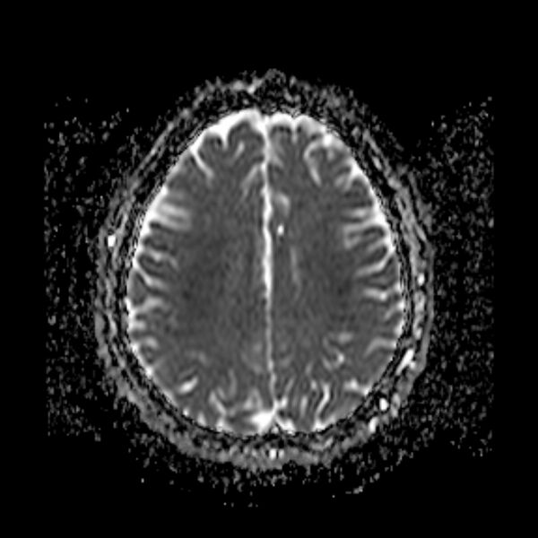 File:Neurofibromatosis type 2 (Radiopaedia 67470-76871 Axial ADC 16).jpg