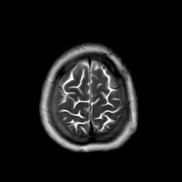 File:Neurofibromatosis type 2 (Radiopaedia 67470-76871 Axial T2 21).jpg