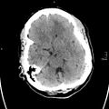Neurotoxoplasmosis - concentric target sign (Radiopaedia 70644-80783 Axial non-contrast 11).jpg