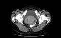 Non-puerperal uterine inversion (Radiopaedia 78343-91094 A 72).jpg