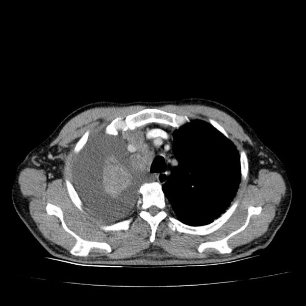 File:Non small-cell lung cancer (Radiopaedia 24467-24769 C+ delayed 16).jpg