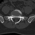 Normal CT lumbar spine (Radiopaedia 53981-60118 Axial bone window 64).jpg