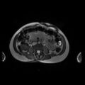 Normal MRI abdomen in pregnancy (Radiopaedia 88001-104541 Axial Gradient Echo 28).jpg