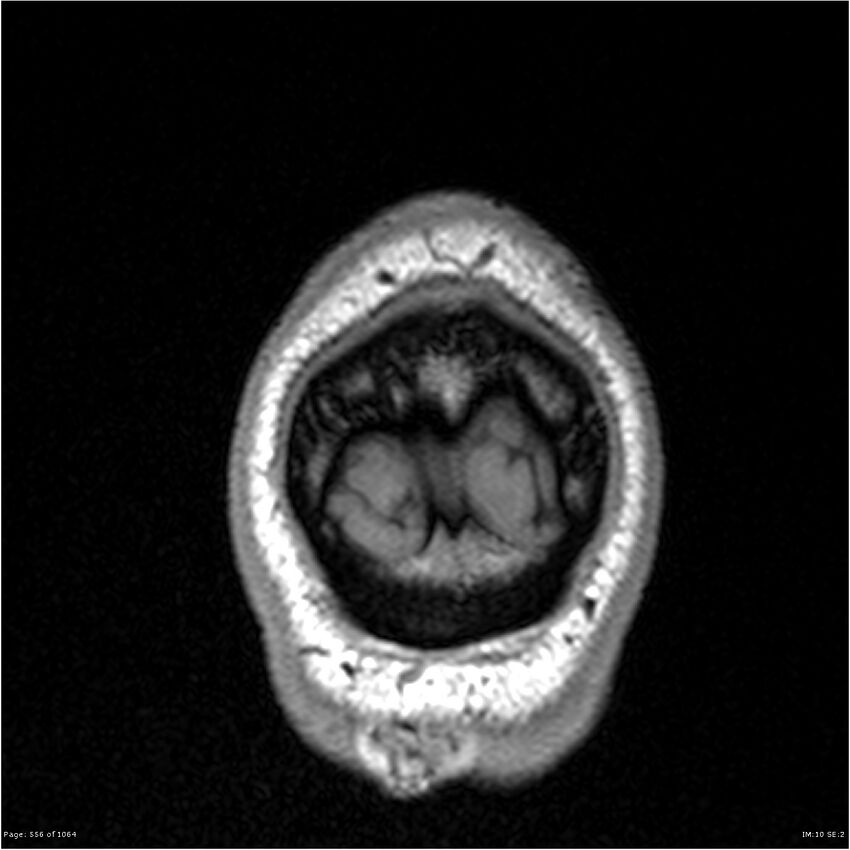 Normal brain MRI (non-focal epilepsy protocol) (Radiopaedia 38571-40700 Coronal T1 4).jpg