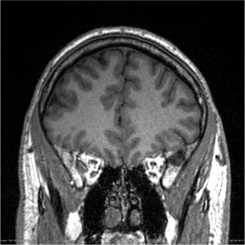 Normal brain MRI (non-focal epilepsy protocol) (Radiopaedia 38571-40700 Coronal T1 79).jpg