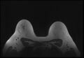 Normal breast MRI - dense breasts (Radiopaedia 80454-93850 Axial T1 178).jpg