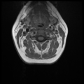 Normal cervical and thoracic spine MRI (Radiopaedia 35630-37156 Axial T1 23).png