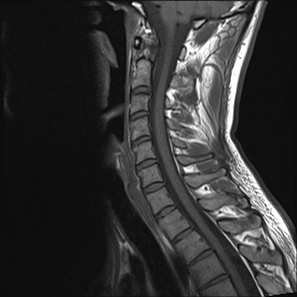 File:Normal cervical spine MRI (Radiopaedia 38418-40496 Sagittal T1 8).jpg
