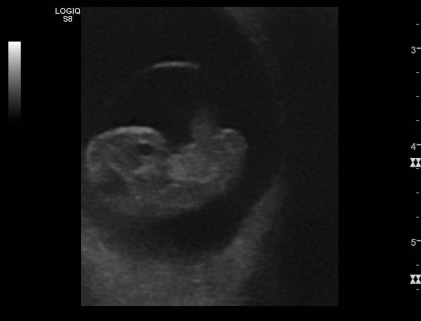 Normal early pregnancy - 8w0d (Radiopaedia 44715-48492 Longitudinal 72).jpg