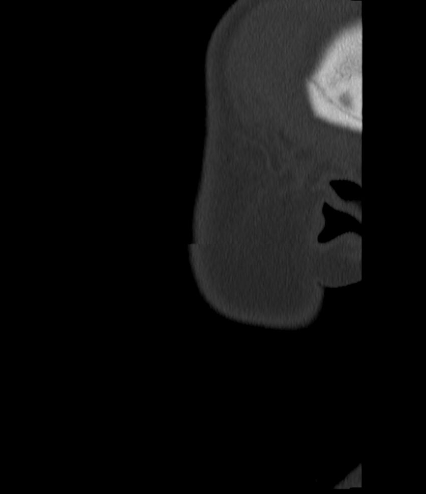 Normal facial bone CT (Radiopaedia 88742-105476 Sagittal bone window 13).jpg