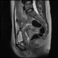 Normal female pelvis MRI (retroverted uterus) (Radiopaedia 61832-69933 Sagittal T2 17).jpg