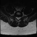 Normal lumbar spine MRI (Radiopaedia 47857-52609 Axial T2 28).jpg