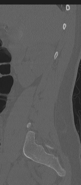 File:Normal lumbosacral CT (Radiopaedia 37923-39867 Sagittal bone window 79).png