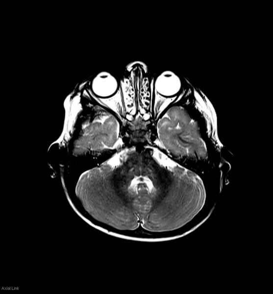 File:Normal myelination 2 year old (Radiopaedia 6815-7983 Axial T2 2).jpg