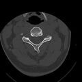 Occipital condyle fracture (Radiopaedia 31755-32691 Axial bone window 33).jpg