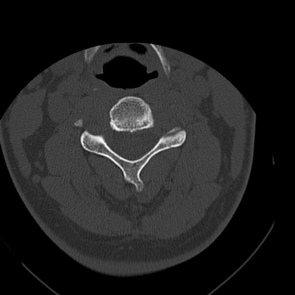 File:Occipital condyle fracture (Radiopaedia 31755-32691 Axial bone window 33).jpg