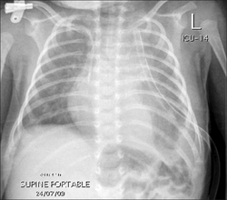 Left chylothorax with chest tube drainage