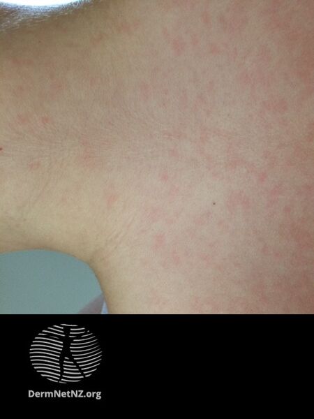 File:Rash due to infectious mononucleosis plus amoxicillin (DermNet NZ ebv-rash-01).jpg