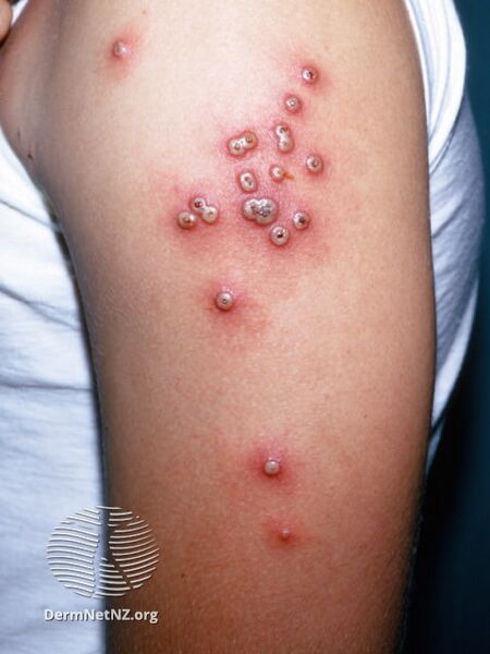 File:Result of smallpox vaccination (DermNet NZ localised-vaccinia).jpg