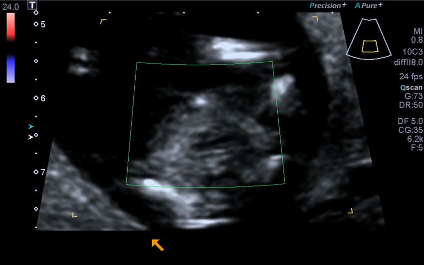 1st trimester nuchal-morphology ultrasound (Radiopaedia 44706-48477 Heart views cine with colour 154).jpg