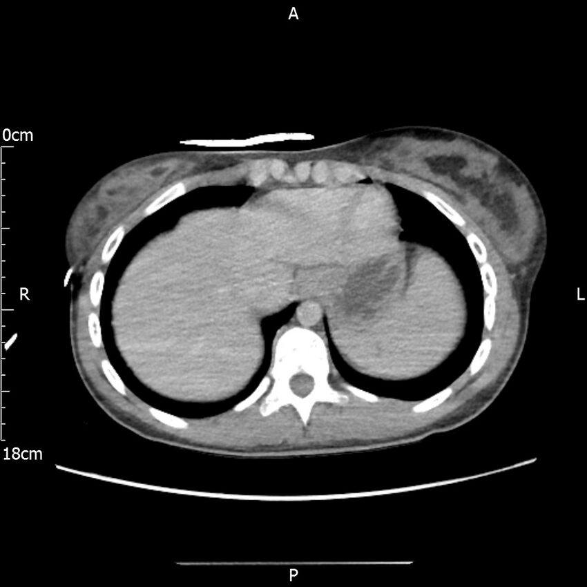 AAST grade IV kidney injury with CEUS follow-up (Radiopaedia 72353-82877 Axial C+ portal venous phase 7).jpg