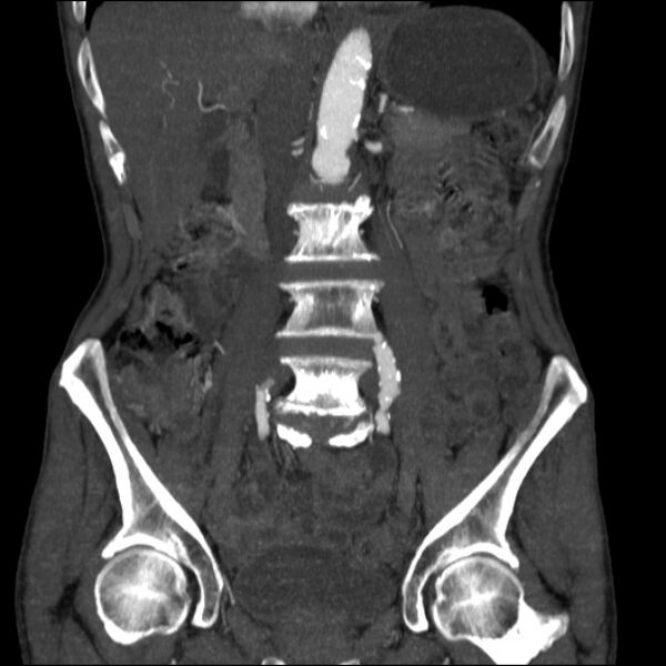 File:Abdominal aortic aneurysm (Radiopaedia 23703-23856 Coronal C+ arterial phase 14).jpg