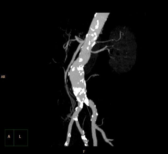 File:Abdominal aortic aneurysm (Radiopaedia 23703-23856 MIP 22).jpg
