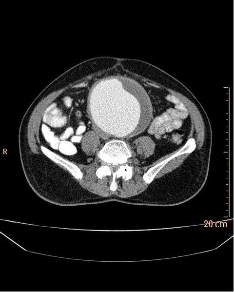 File:Abdominal aortic aneurysm (Radiopaedia 25985-26121 Axial C+ arterial phase 25).jpg