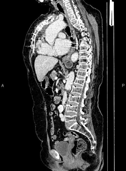 File:Abdominal aortic aneurysm (Radiopaedia 85063-100606 Sagittal C+ arterial phase 42).jpg