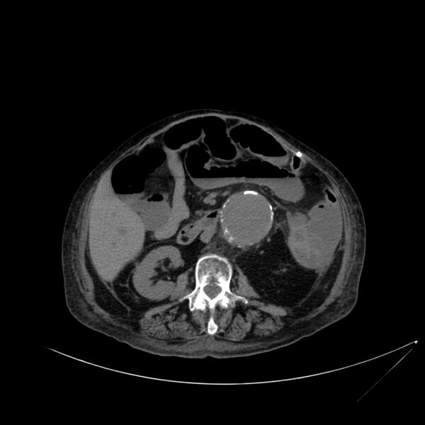 File:Abdominal aortic aneurysm - impending rupture (Radiopaedia 19233-19246 Axial non-contrast 62).jpg