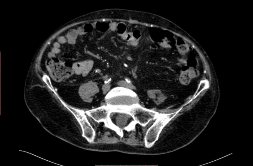 Abdominal aortic interposition tube graft and aneurysm thrombosis (Radiopaedia 71438-81857 Axial C+ arterial phase 140).jpg