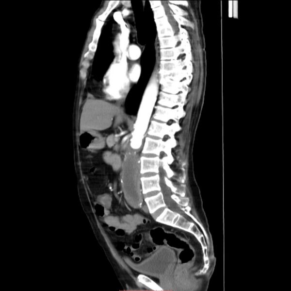 File:Abdominal aortic interposition tube graft and aneurysm thrombosis (Radiopaedia 71438-81857 Sagittal C+ arterial phase 16).jpg
