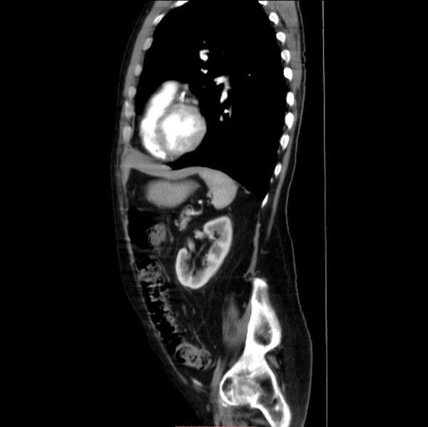 File:Abdominal aortic interposition tube graft and aneurysm thrombosis (Radiopaedia 71438-81857 Sagittal C+ arterial phase 8).jpg